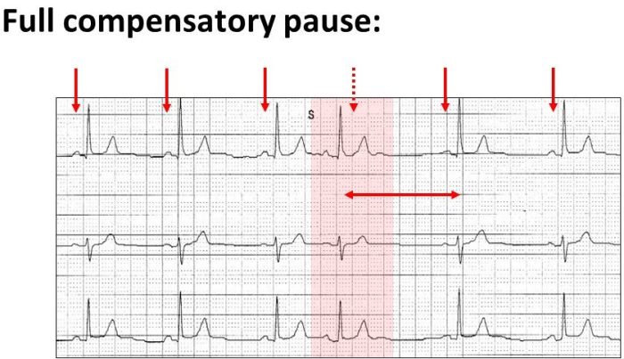 Compensatory pause vs noncompensatory pause