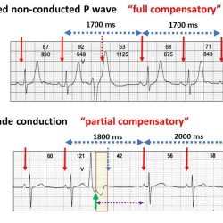 Compensatory pause vs noncompensatory pause