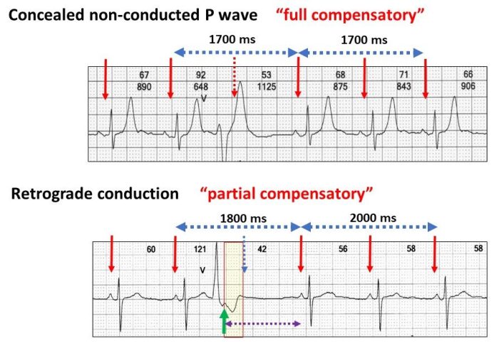 Compensatory pause vs noncompensatory pause